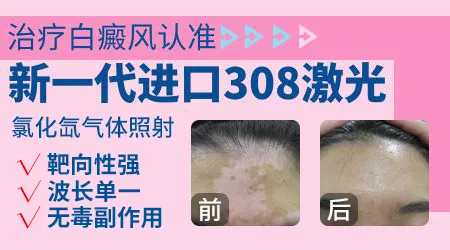 儿童白癜风能不能用308准分子光疗