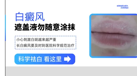 早期白斑用遮盖液会影响治疗吗