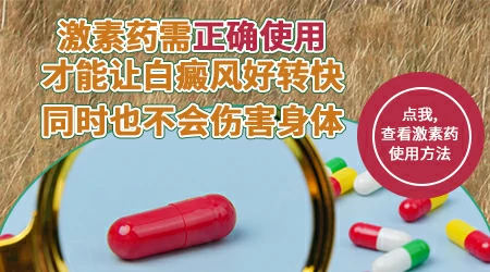 白癜风吃激素药多吃几天就要停