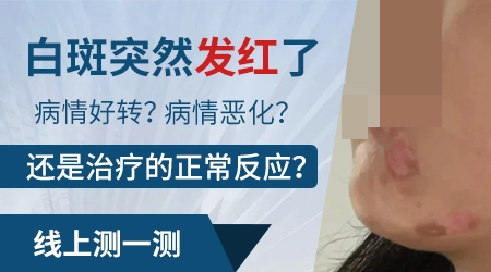 白癜风白斑处发红是好的表现吗