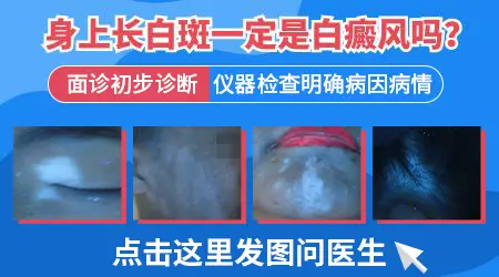 局部皮肤瘙痒之后长出白斑是白癜风吗