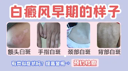 白癜风早期有哪些特殊症状 如何与其它白斑区分