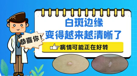 皮肤白斑区界限清楚好还是不好