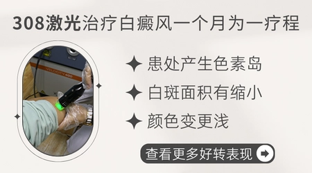 308准分子激光治白癜风几次能见效