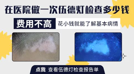 儿童白癜风多次伍德灯检查对身体有伤害吗