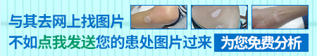 身上有几个白点是白癜风吗