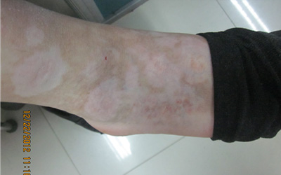 脚背刚发现光滑的白斑不痒是什么