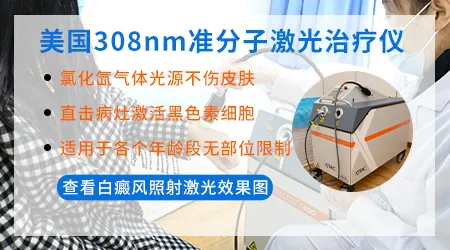 白癜风做完火针多久可以照激光