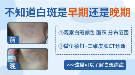 现在哪种方法治疗白癜风见效快