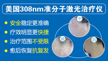 头皮上早期白癜风图片 