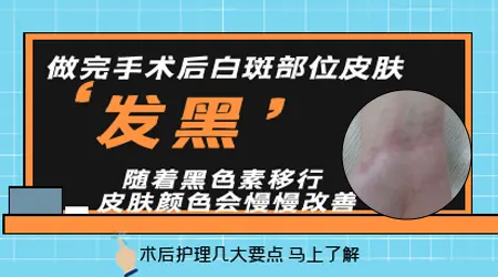 白癜风种植手术后长黑色素岛什么样