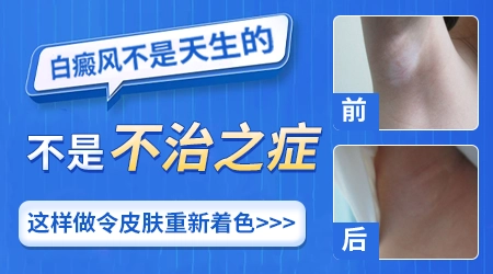 半导体激光治疗仪照白癜风真的有用吗