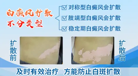 大部分白癜风都会扩散吗