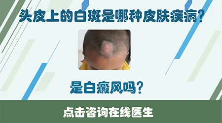 孩子头皮出现白斑伴白发怎么办