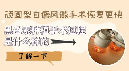 白癜风种植手术一次成功的几率多少