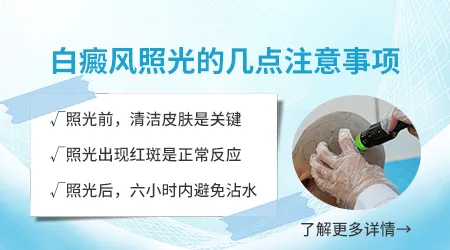 白癜风照紫外线灯一次照多长时间效果好