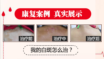2020年白癜风治好的案例