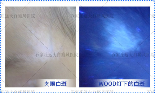 WOOD灯检查白斑是浅白色