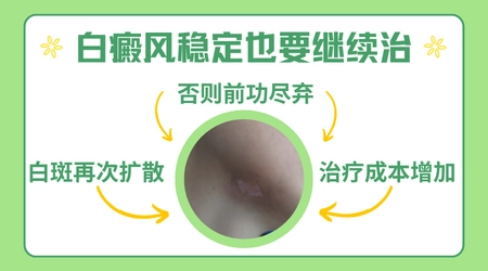 身上的白癜风稳定期有什么症状