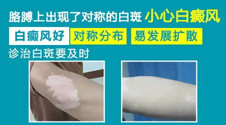 身上对称长白斑是什么病