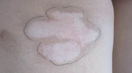 大腿两边都有白癜风怎么治疗