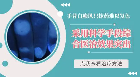手背上白癜风擦芦可替尼恢复概率高吗