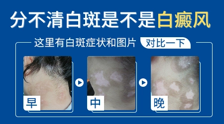 男孩两腮长白斑图片