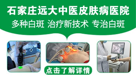 石家庄哪里看白癜风看得好