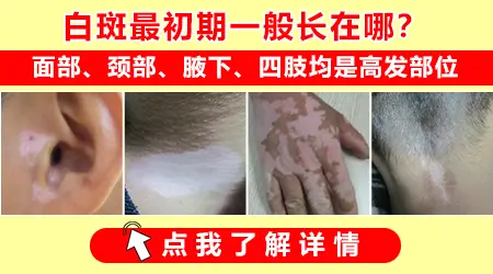 颈部蚕豆大小白斑是什么