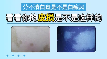 男性大拇指上出现花生大的白是什么原因
