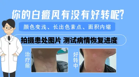 白斑恢复的好转图片