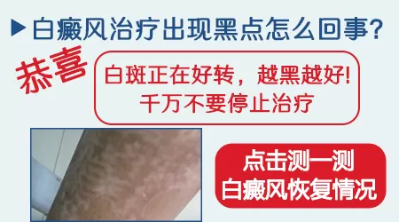 308激光治疗白癜风后出现黑点什么原因