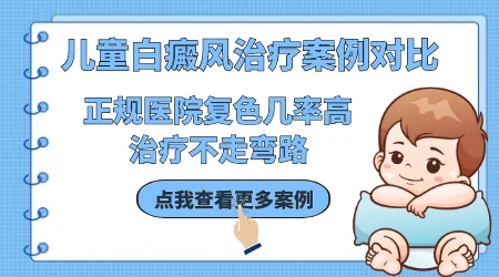 儿童得了白癜风用什么治疗方法更安全