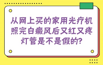 网上买的紫外线光疗仪有假的吗