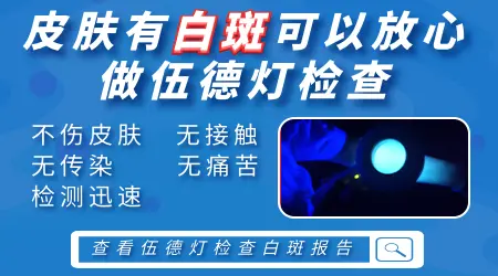wood灯显示无荧光能排除是白癜风吗