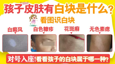 宝宝脸上出现白色的斑块是怎么回事