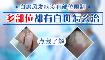 身上多个部位白癜风怎么治 早期白癜风治疗方法