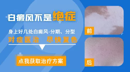 女性长白斑是什么原因