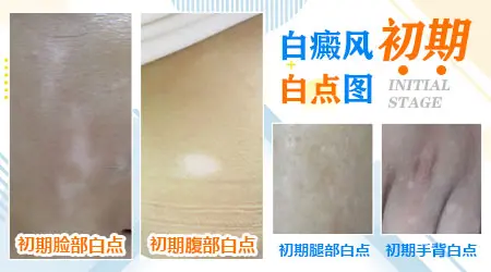腿上有多个大小不等的白斑是什么