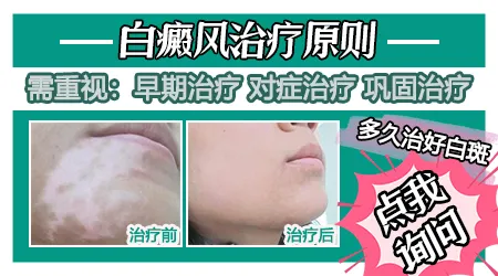 白斑和白癜风误诊案例对比图