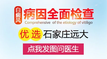 儿童白癜风诱发因素