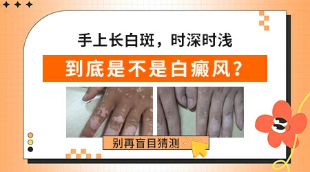 手上的白斑怎么看是白癜风还是其他白斑