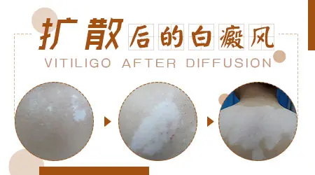 皮肤白点会慢慢变大是白癜风的症状吗