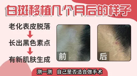 白癜风种植手术多久会长出黑色素