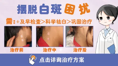 白癜风会通过夫妻生活传染吗