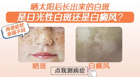 日光性白斑和白癜风怎么区分