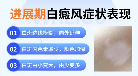 白癜风进展期能不能照美国308nm准分子激光