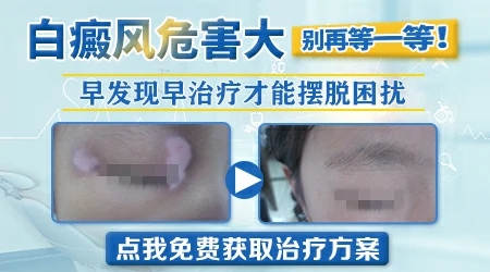 白癜风眉毛可以纹眉吗