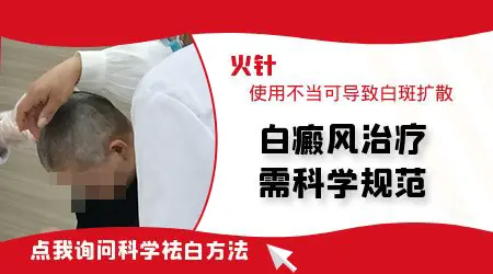 火针治疗白癜风效果好不好