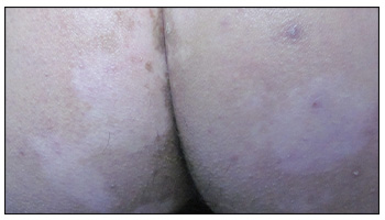 肛门黏膜白斑症状及图片